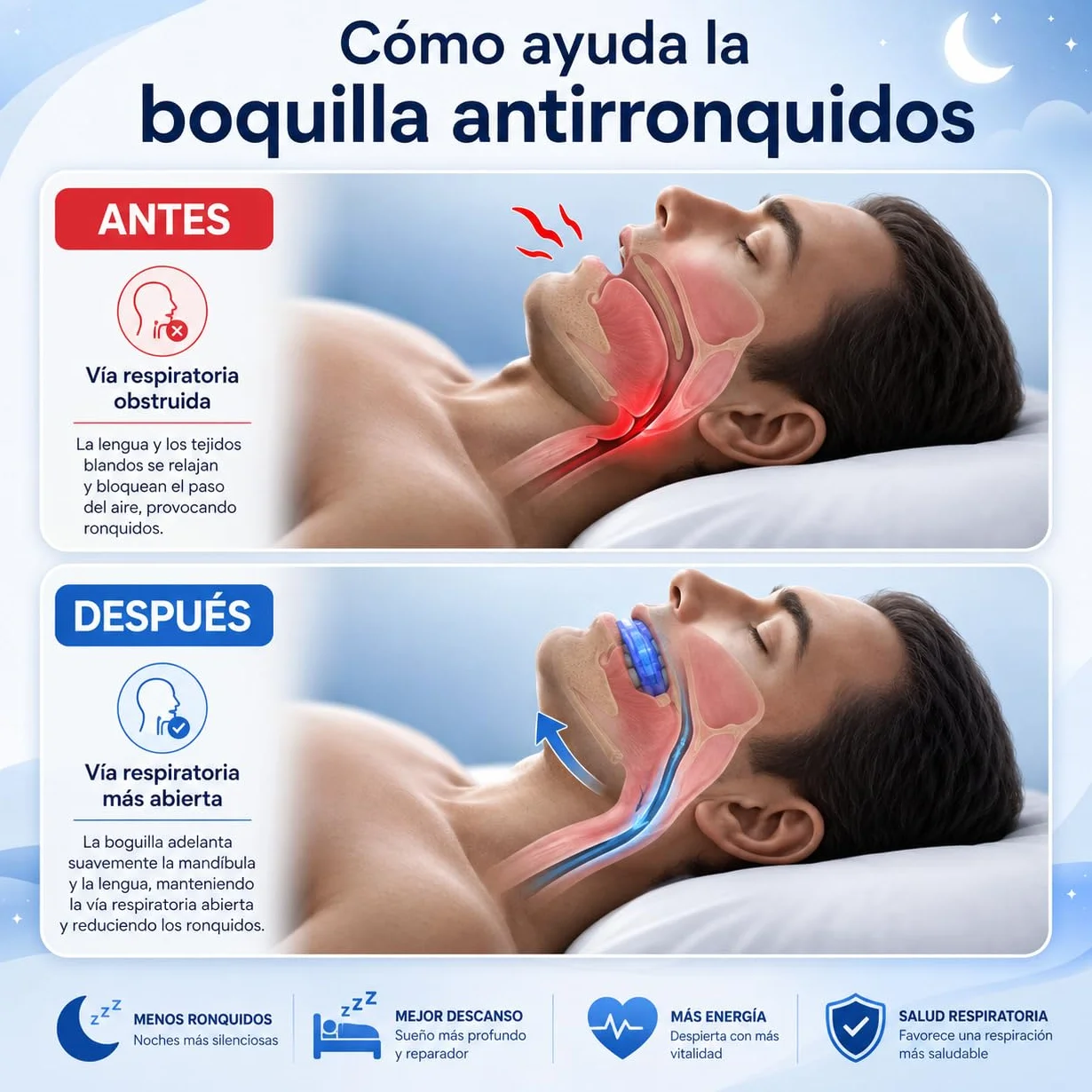 Férula Antirronquidos Ajustable, Dispositivo de Avance Mandibular Termomoldeable